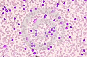 Moderate blast cell of white blood cells in blood smear