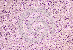 Moderate blast cell of white blood cells in blood smear