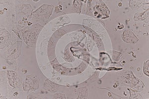 Moderate epithelial cells in urine specimen photo