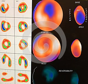 Moderate myocardial ischemia image