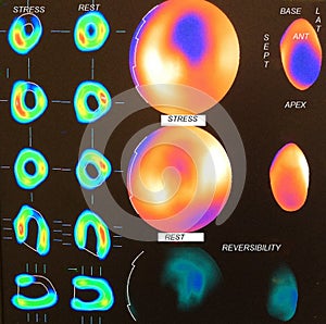 Moderate myocardial ischemia image