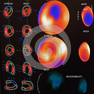 Moderate myocardial ischemia image photo