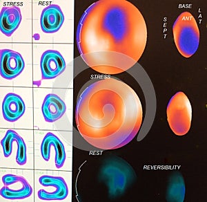 Moderate myocardial ischemia image photo