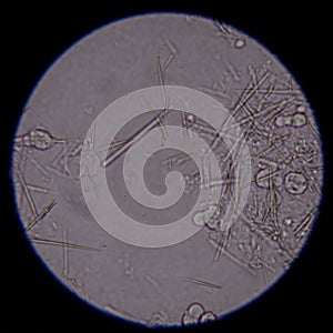 Moderate Uric acid crystal needle shape.