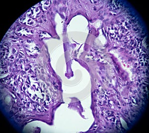 Moderately Differentiated Neuroendocrine Carcinoma Atypical Carcinoid