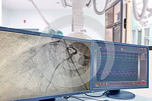 Modern Cath Lab showing LCD monitor with the doctor, nurse, and patient in the hospital, patient during treatment in Cath Lab