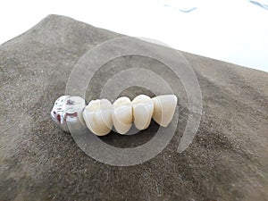 Modern ceramic-metal dental bridge for restoring dentition photo