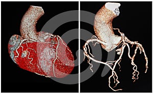 Coronary CT-scan angiography. Modern reconstruction photo