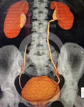 Modern ct scan of renal hydronephrosis pathology