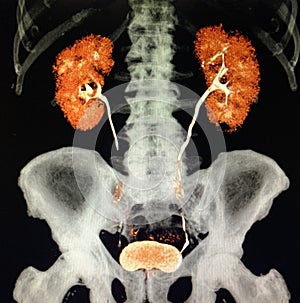 Modern ct urogram  colorful   structure kidneyes