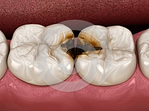 Molar teeth damaged by caries. Medically accurate tooth 3D illustration