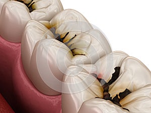 Molar teeth damaged by caries. Medically accurate tooth 3D illustration