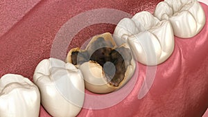 Molar teeth damaged by caries. Medically accurate tooth animation