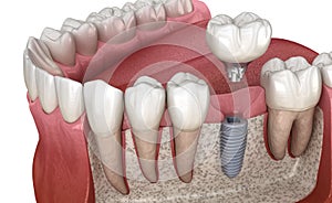 Molar tooth crown installation over implant abutment. Medically accurate 3D illustration of human teeth and dentures concept