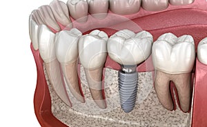 Molar tooth crown installation over implant abutment. Medically accurate 3D illustration of human teeth and dentures concept