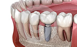 Molar tooth crown installation over implant abutment. Medically accurate 3D illustration of human teeth and dentures concept photo