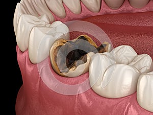 Molar tooth damaged by caries. Medically accurate tooth 3D illustration