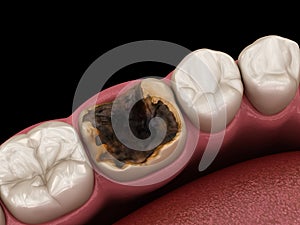 Molar tooth damaged by caries. Medically accurate tooth 3D illustration