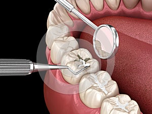 Molar tooth fissure restoration with filling. Medically accurate tooth 3D illustration photo