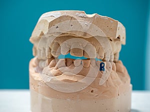 MOLD OF THE TEETH OF A CHILD WITH MISPLACED TEETH