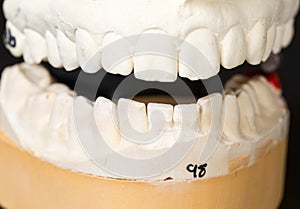 Mold of teeth taken for orthodontics