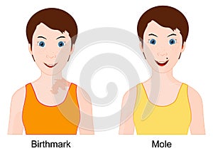 Mole and Birthmark. Comparison and difference