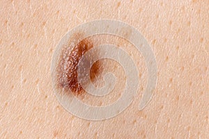 Mole birthmark nevus macro photo on human skin. Close up