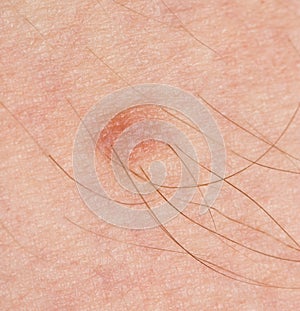 Mole on the human skin. macro