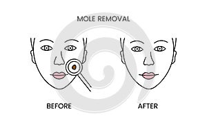 Mole removal, laser cosmetology before procedure and after applying treatment line icon in vector. Illustration of a