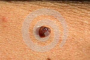 Mole on the skin of the body. Birthmark. Acrochordon.