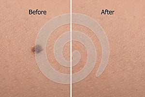 mole on woman skin before after laser treatment