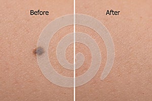 Krtek na žena kůže před po laserový paprsek léčba 