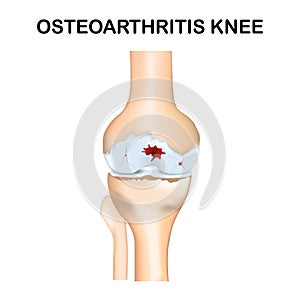 Molecular structure osteoarthritis pain background. Abstract traumatology and orthopedics