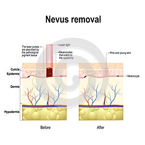 Moles spots or nevus removal photo