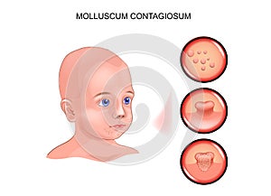 Molluscum contagiosum in a child photo