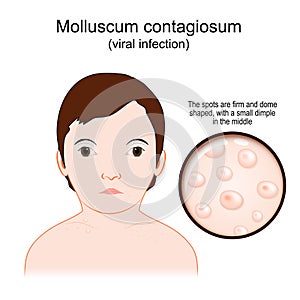 Molluscum contagiosum. Water warts photo