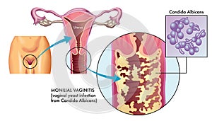 Monilial vaginitis illustration