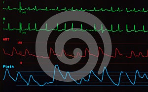 Monitor with Atrial Fibrillation photo