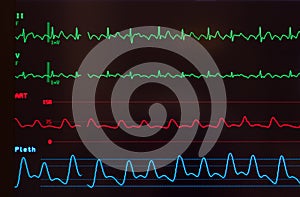 Monitor with Atrial Flutter