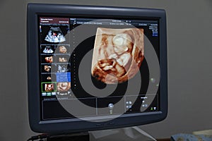 Monitor with baby images in the process of gestation.