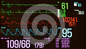 Monitor Showing Intraventricular Conduction Delay and Vital Signs