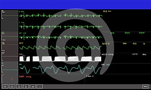 Monitoring display of patient vital signs