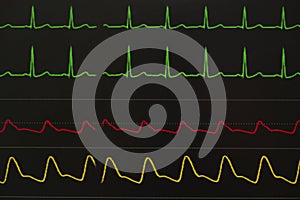 Monitoring displays of patient vital signs