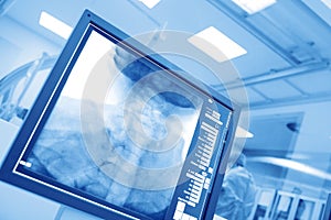 Monitoring the operation in cathlab