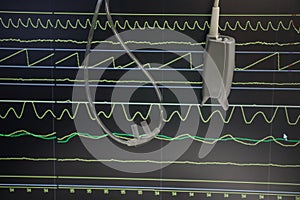 Monitoring of patient in hospital.