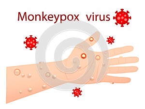 Monkeypox virus that can infect human, Monkey pox. photo