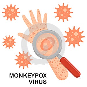 Monkeypox virus on hand and arm. Monkeypox Virus Outbreak as a contagious infection as blisters and leisons. Vector illustration