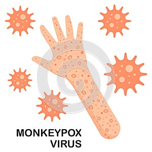 Monkeypox virus on hand and arm. Monkeypox Virus Outbreak as a contagious infection as blisters and leisons. Vector illustration