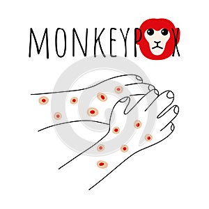Monkeypox virus symptom doodle concept. Monkey face and hands with rash. Monkey pox script. Viral smallpox disease