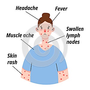 Monkeypox virus symptom infographic on woman patient with fever, headache, swollen lymph node, rashes on face, body and